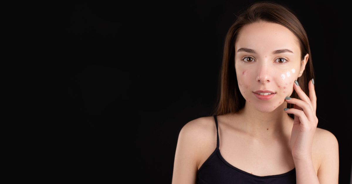 découvrez les meilleurs traitements contre l'acné pour une peau claire et saine. conseils, soins adaptés et solutions efficaces pour lutter contre les boutons et imperfections.