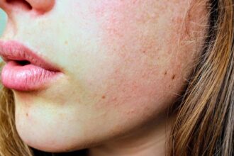 découvrez des conseils efficaces pour prendre soin de votre peau grasse, réduire la brillance et prévenir les imperfections grâce à des routines adaptées.