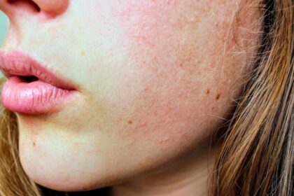 découvrez des conseils efficaces pour prendre soin de votre peau grasse, réduire la brillance et prévenir les imperfections grâce à des routines adaptées.